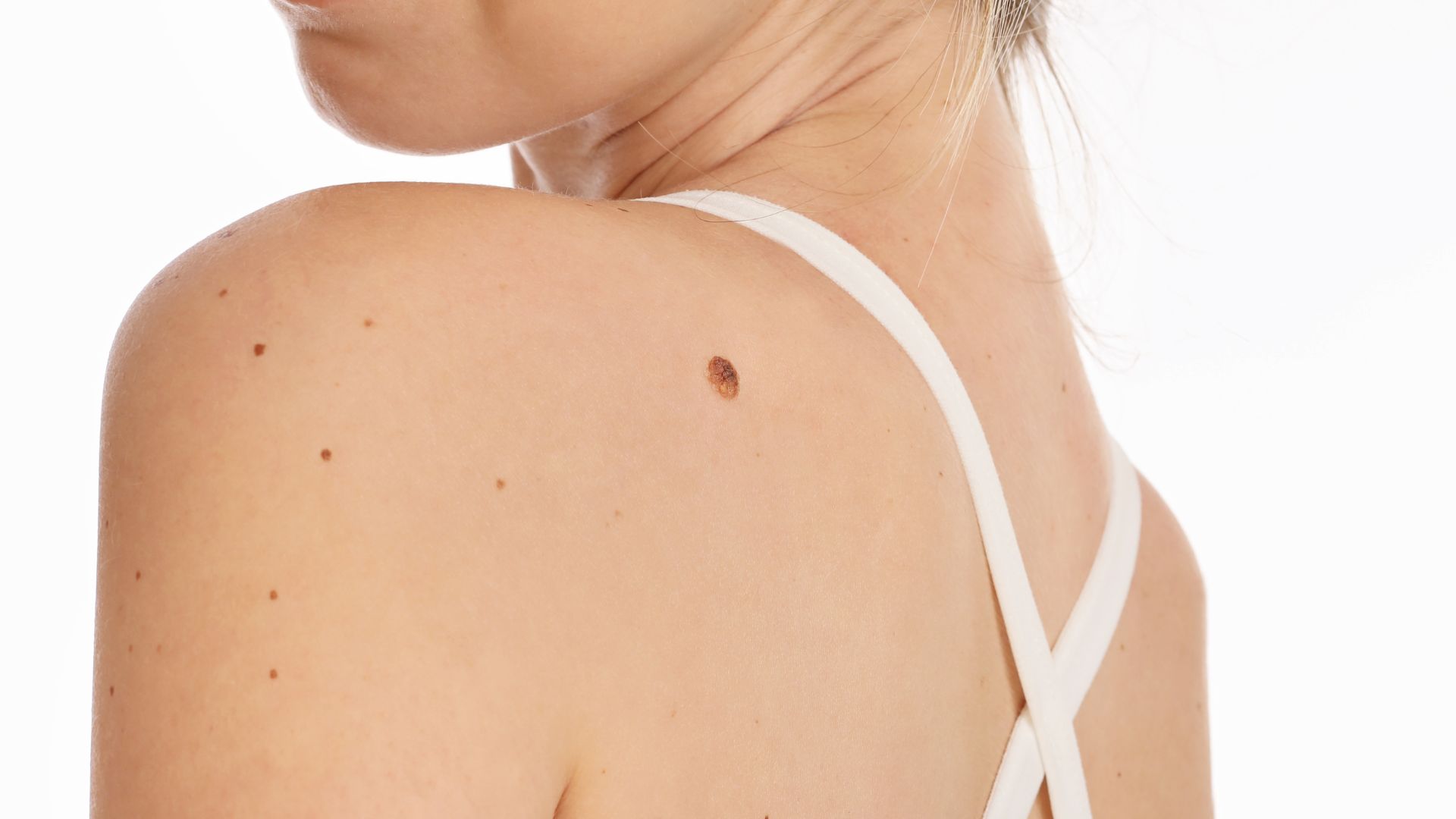 Kaiser Blog Girls back with a mole